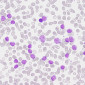 Un equip internacional d’investigadors completa el mapa genòmic de la leucèmia limfàtica crònica
